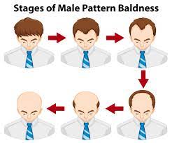 Hair Balding stages